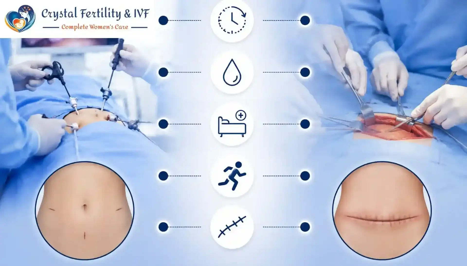 Laparoscopic Surgery